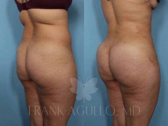 Brazilian Butt Lift Before and After 2