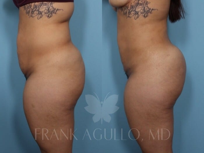 Brazilian Butt Lift Before and After 3