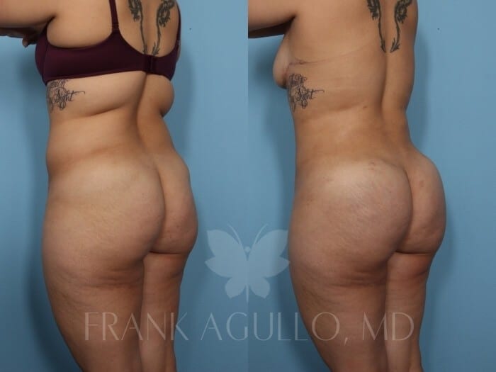 Brazilian Butt Lift Before and After 4