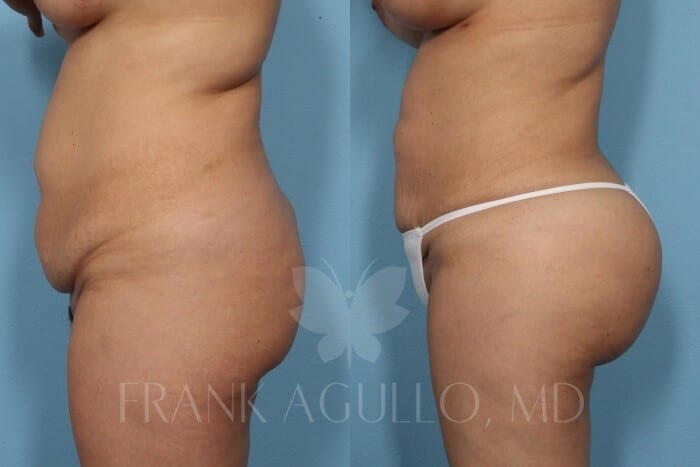 Brazilian Butt Lift Before and After 8