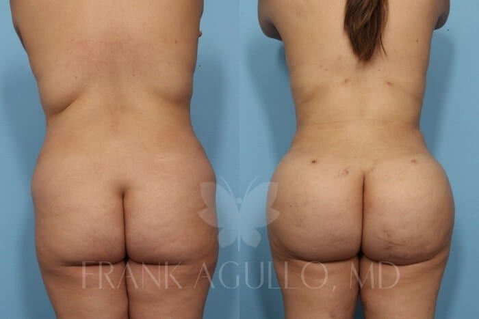 Brazilian Butt Lift Before and After 3