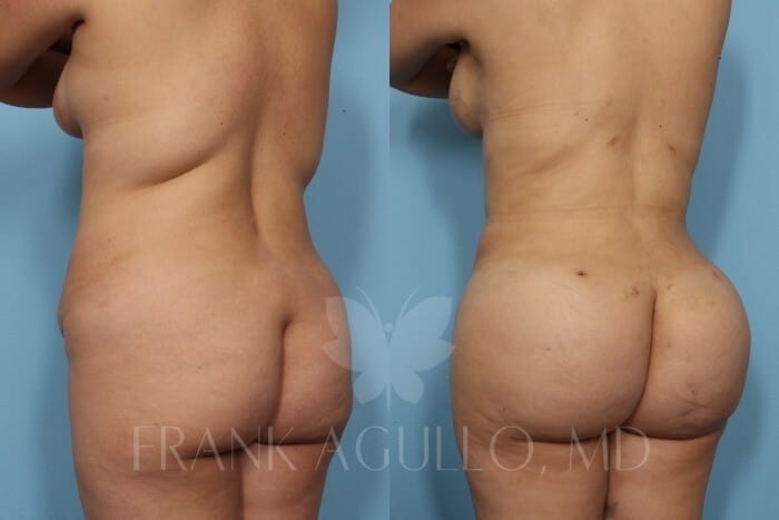 Brazilian Butt Lift Before and After 4