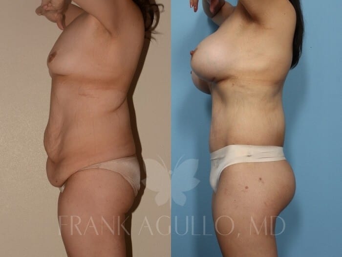 Body Lift Before and After 2