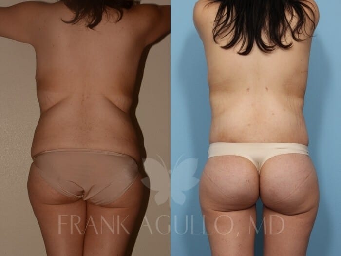 Body Lift Before and After 3
