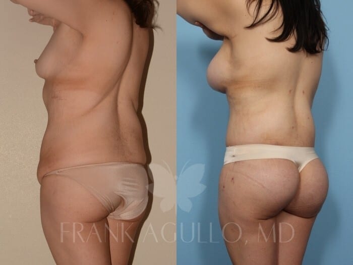 Body Lift Before and After 4