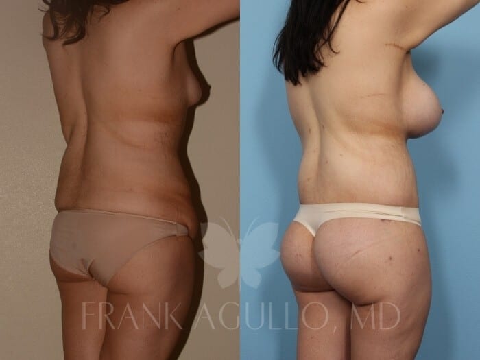 Body Lift Before and After 5