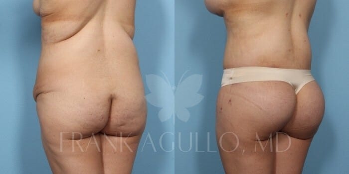 Body Lift Before and After 6