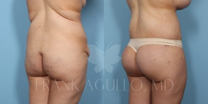 Body Lift Before and After 7