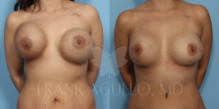 Breast Revision Before and After 3