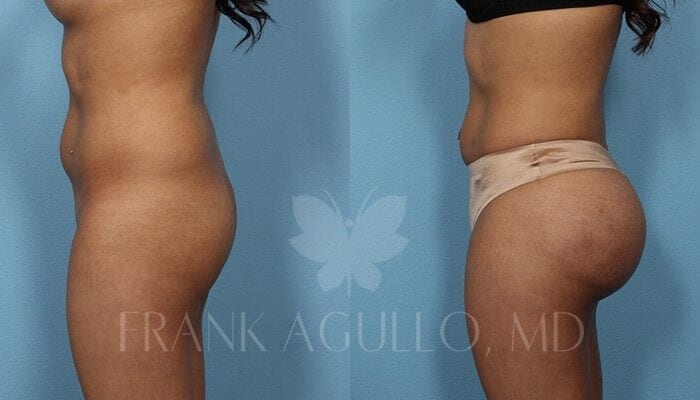 Butt Implants Before and After 10