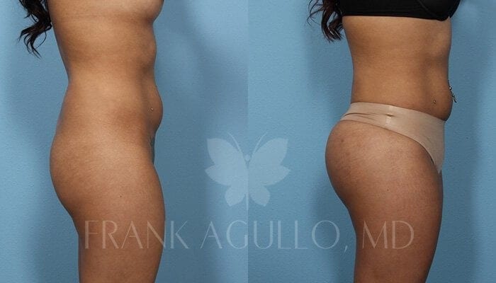 Butt Implants Before and After 3