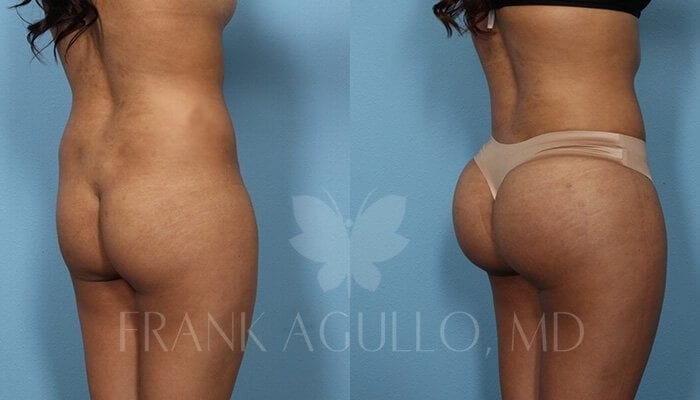 Butt Implants Before and After 4