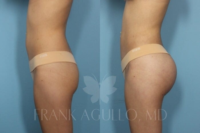 Before & After Butt Implants Photos - Page 2 of 31 - Frank Agullo, MD
