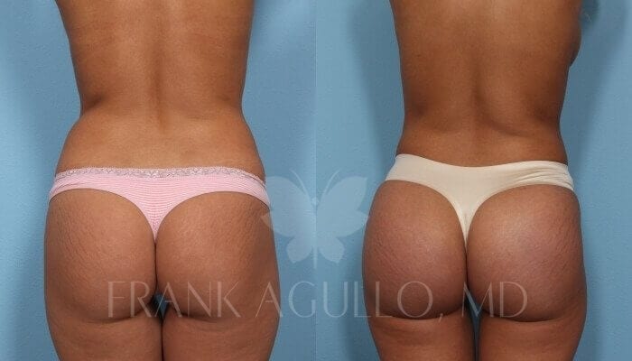 Butt Implants Before and After 9