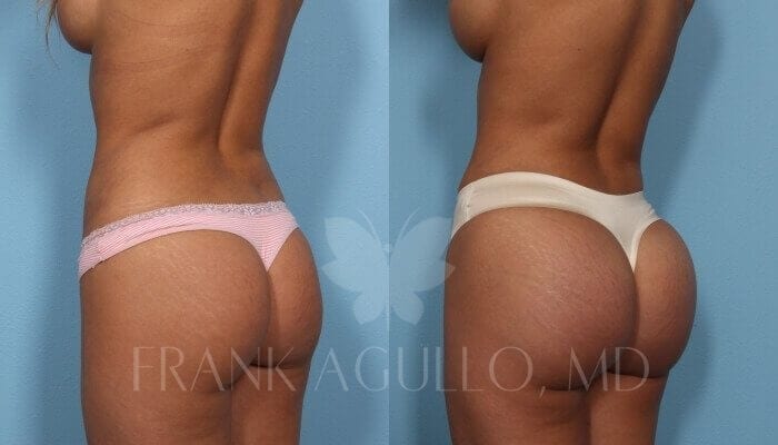 Butt Implants Before and After 2