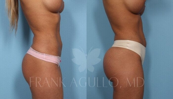 Butt Implants Before and After 4