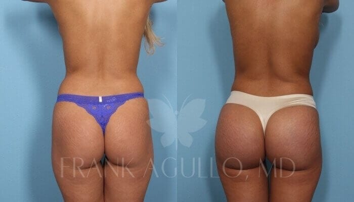 Butt Implants Before and After 8