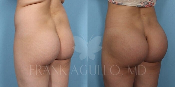 Butt Implants Before and After 5
