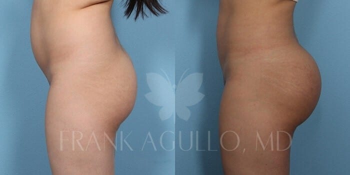 Butt Implants Before and After 7