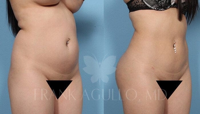 Butt Implants Before and After 9