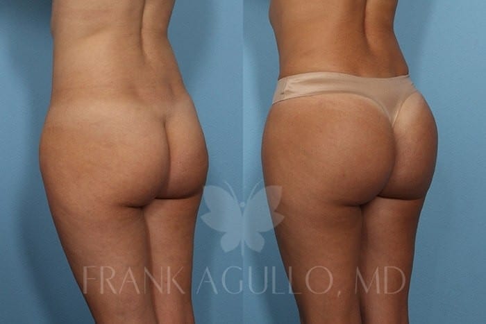 Butt Implants Before and After 20