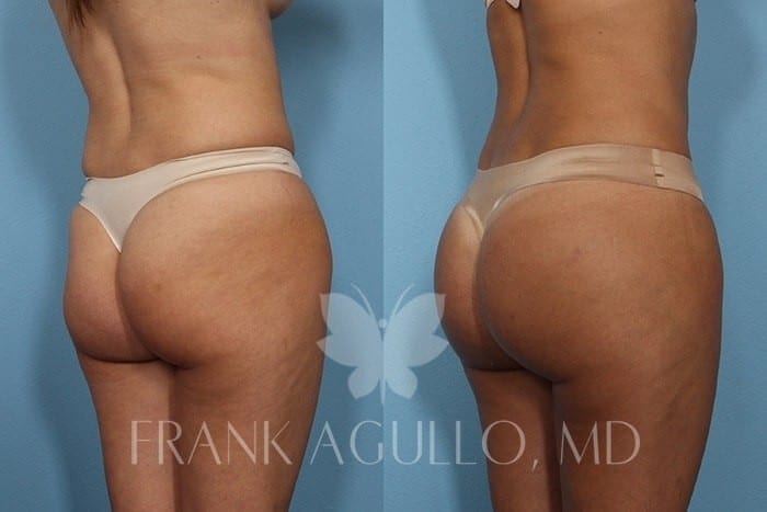 Butt Implants Before and After 2