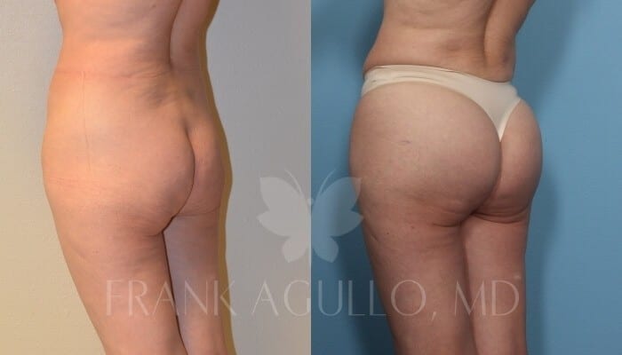 Butt Implants Before and After 3