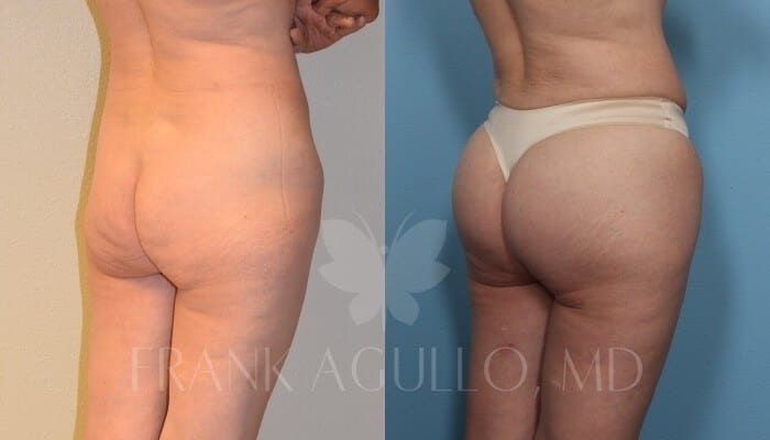 Butt Implants Before and After 4
