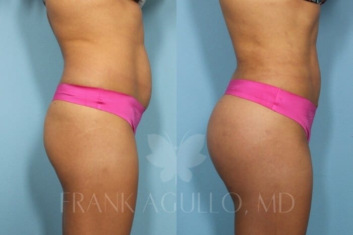 Butt Implants Before and After 5