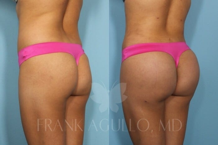 Butt Implants Before and After 4