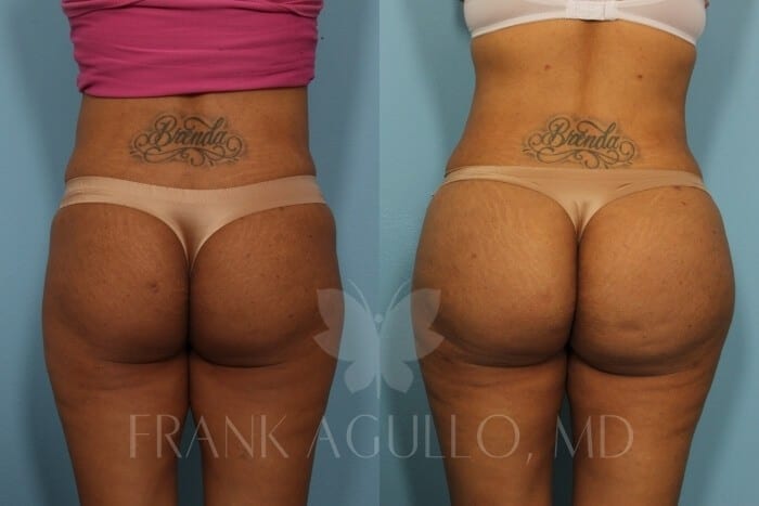 Butt Implants Before and After 5