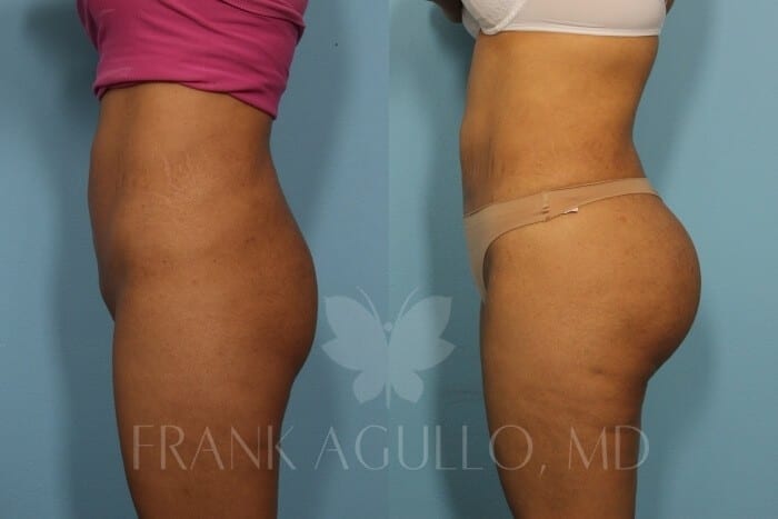 Butt Implants Before and After 3