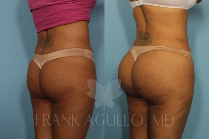 Butt Implants Before and After 2