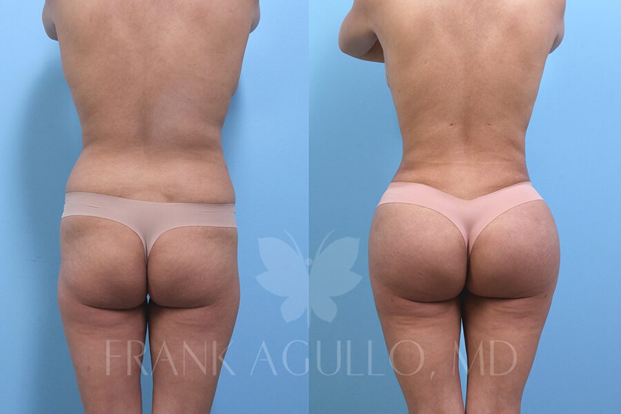 Brazilian Butt Lift Before and After 9