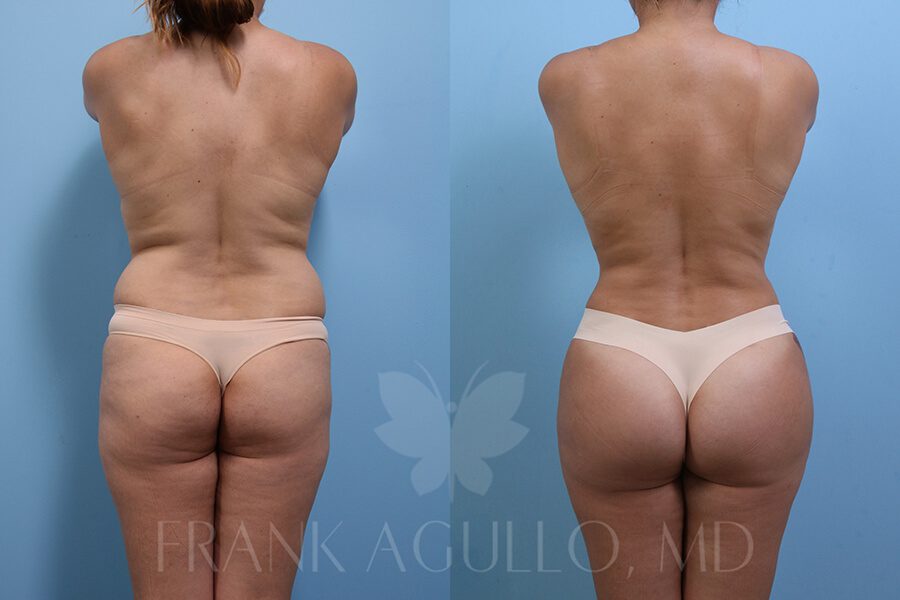 Brazilian Butt Lift Before and After 7