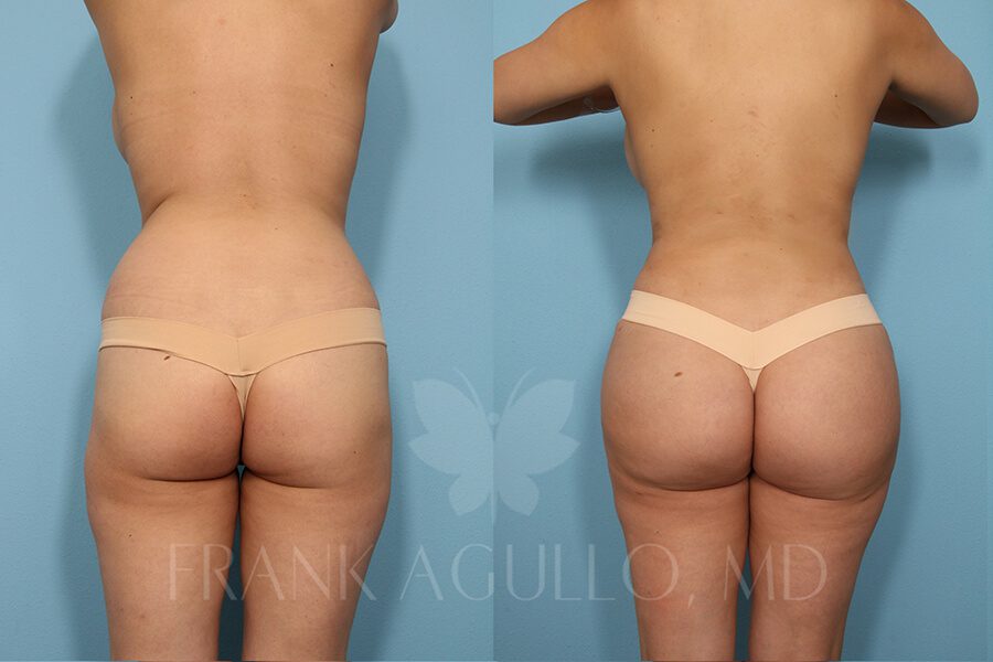 Brazilian Butt Lift Before and After 6