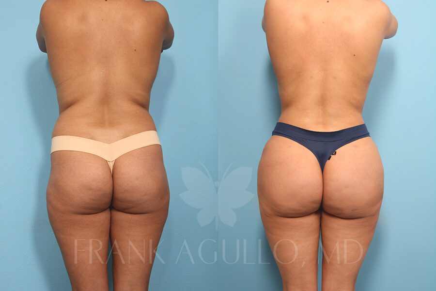 Brazilian Butt Lift Before and After 5