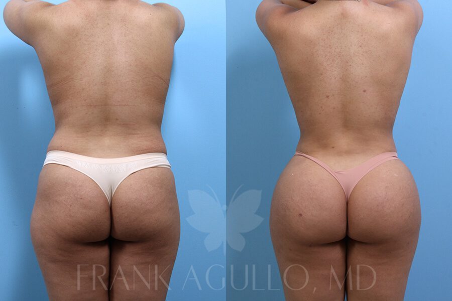 Brazilian Butt Lift Before and After 4