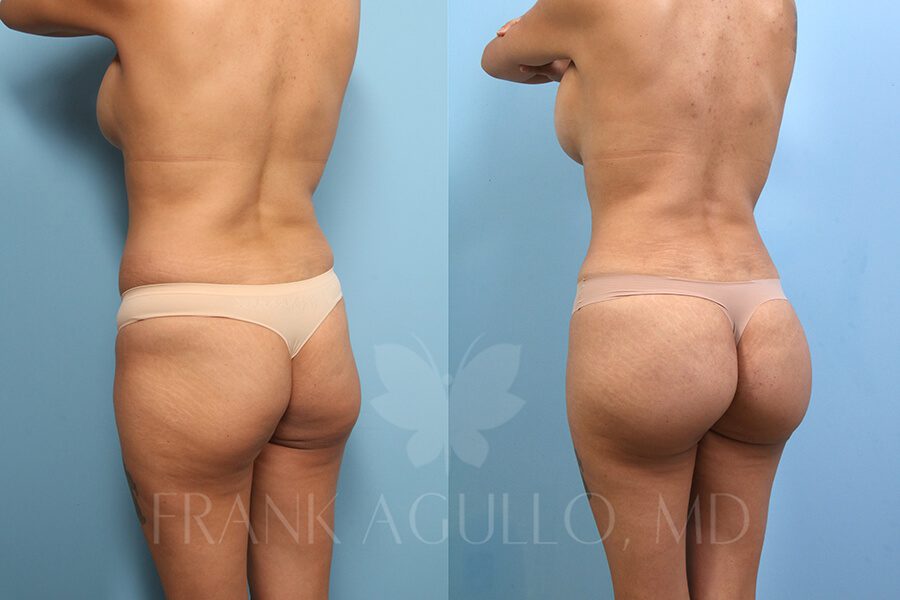 Brazilian Butt Lift Before and After 2