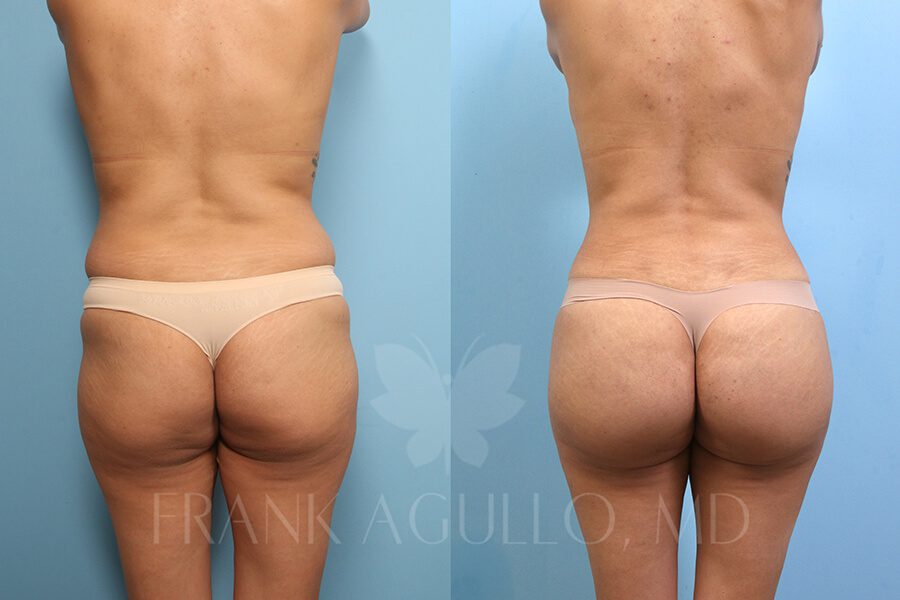 Brazilian Butt Lift Before and After 3