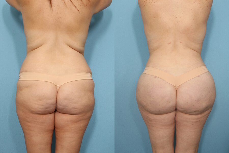 Brazilian Butt Lift Before and After 2
