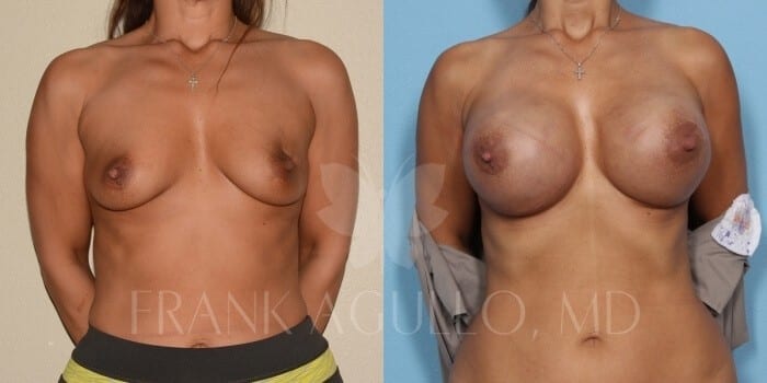 Breast Reconstruction Before and After 1