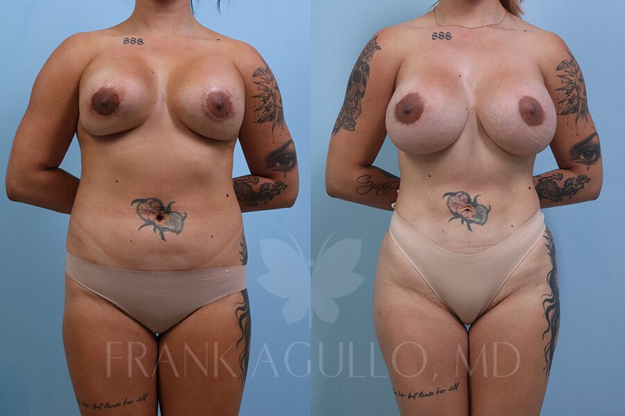 Breast Revision Before and After 1