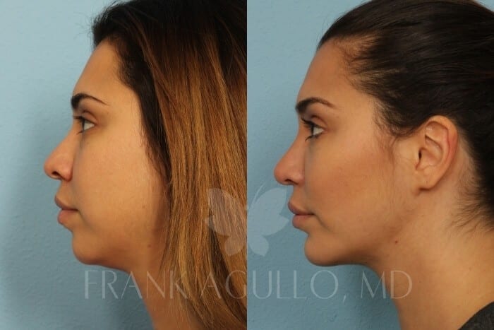 Buccal Fat Pad Removal Before and After 2