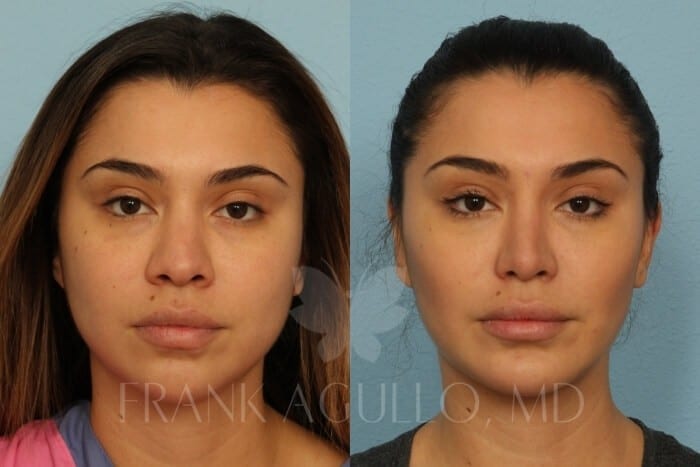 Buccal Fat Pad Removal Before and After 2