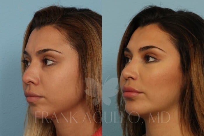 Buccal Fat Pad Removal Before and After 3