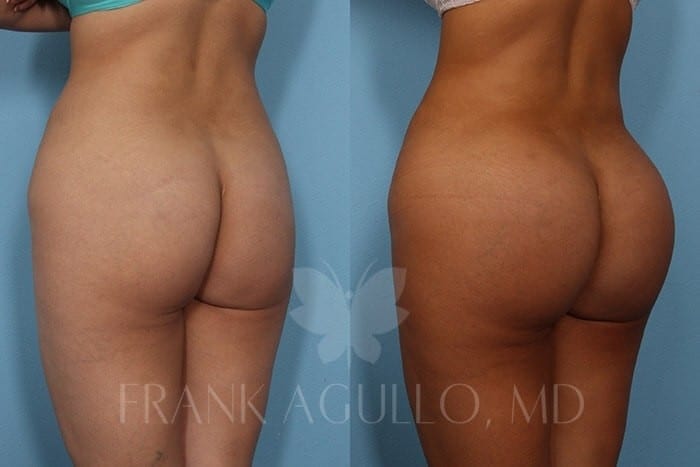 Butt Implants Before and After 7