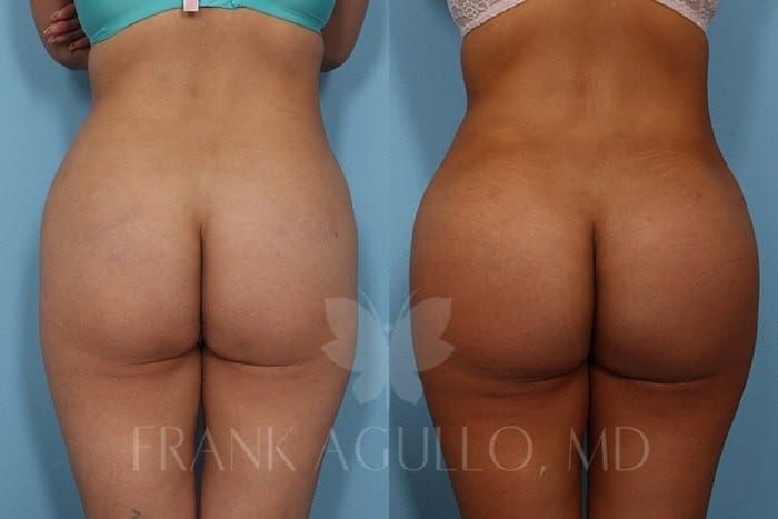 Butt Implants Before and After 3