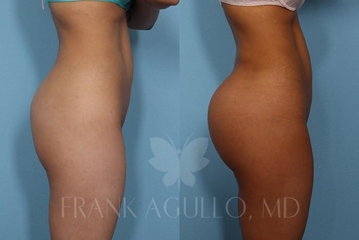 Butt Implants Before and After 5