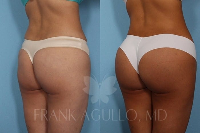Butt Implants Before and After 6